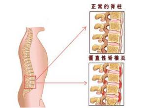 强直性脊柱炎典型症状.jpg