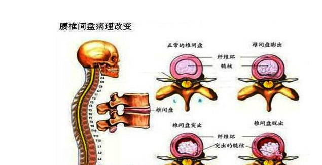 腰椎间盘膨出你了解吗？