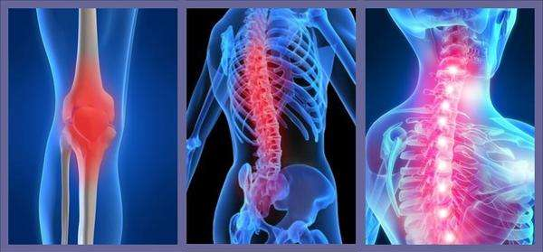 强直性脊柱炎的诊断标准是什么？